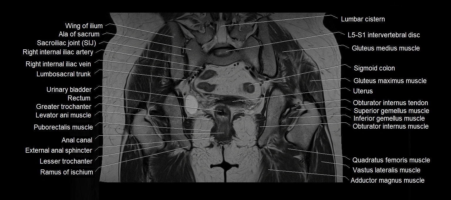MRI 3T pelvis coronal cross section anatomy image 17.webp